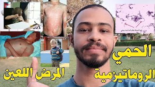 الحمي الروماتيزمية (اسباب، اعراض، تشخيص، علاج)