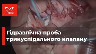 Гідравлічна проба трикуспідального клапану 🔷 Інститут серця