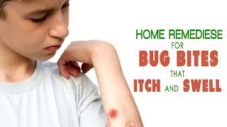 Home remedies for bug bites that itch and swell