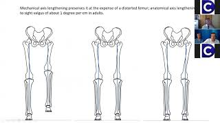 WEBINAR 2 - DEFORMITY CORRECTION AND THE LENGTHENING NAILS