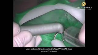 Laser activated irrigation with LiteTouch™ Er:YAG laser