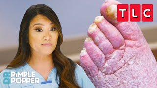 Rare Medical Conditions | Dr. Pimple Popper | TLC