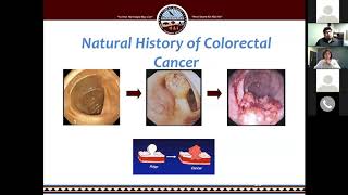 Community Health Webinar Series: Colorectal Cancer 101