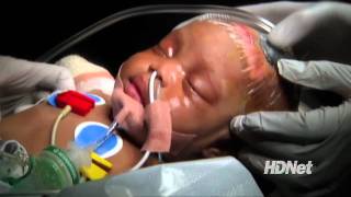 The Miracle Baby of Haiti