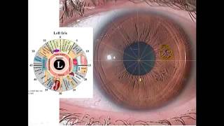 Iridology Overview for a Brown Iris with Nerve Rings