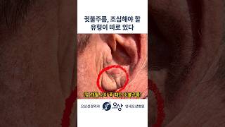 귓불주름을 조심해야 할 유형 #shorts