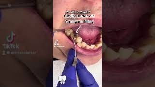 Caries under old amalgam restoration