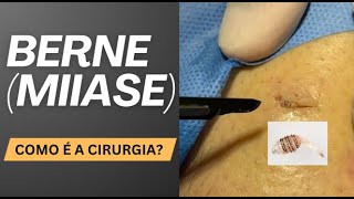 Miíase (berne) o que é? Como é a cirurgia? Por Dr. Luiz Gameiro, dermatologista