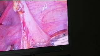 استئصال الزائدة الدودية بالتنظير  &Laparoscopic appendectomy  الدكتور صهيب هويدي