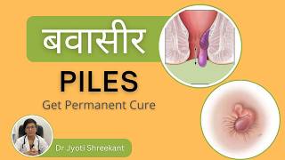 Piles ka gharelu ilaaj | Piles problem treatment in Hindi | piles symptoms hindi | Piles medicine