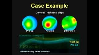 Corneal Biomechanics: What Should Every Refractive Surgeon Know?