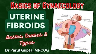 Fibroid Uterus : Basics | What they are? Types & causes