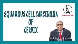 SQUAMOUS CELL CARCINOMA OF CERVIX