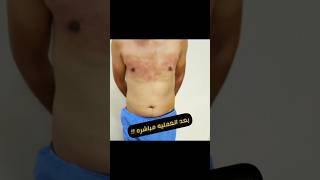 Gynecomastia surgery in Egypt Dr Mohamed Elhitamy علاج التثدى عند الرجال فى مصر د محمد الهيتمى