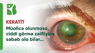 Ən təhlükəli göz xəstəliklərdən biri - #Keratit. Gözün buynuz qişasının iltihabi xəstəliyi