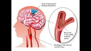 Stroke (Cerebrovascular Accident)