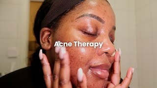 romanticising my acne scars | skin care therapy #skincaretherapy #acnescars