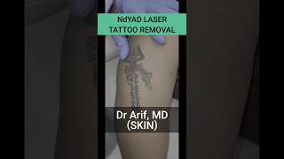 Laser tattoo removal@DrArifMDDermatologist #tattoo #lasertattooremoval