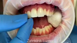 Veneers Smilemakeover - Zahnklinik Luzern Dr.Dr.Rosanna Himmelfarb