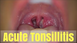 Acute Tonsillitis