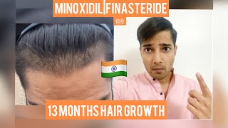 My SHOCKING 13 Months Minoxidil Finasteride Results| Receding hairline Growth| 13 months hair| hindi