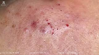 Big Cystic Acne Blackheads Extraction Blackheads & Milia, Whiteheads Removal Pimple Popping