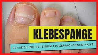 EINGEWACHSENEN NAGEL mit einer KLEBESPANGE behandeln | Podostripe Klebespange