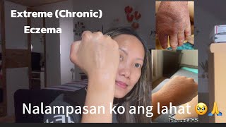 Awareness hindi biro ang dinanas ko sakit na ito🙏 | Eczema | filipinainAustria |Lou&Rici