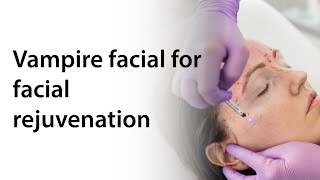 Vampire facial for facial rejuvenation