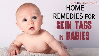 Home Remedies for Skin Tags In Babies | ActiveMomsNetwork