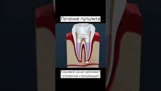 Открытую пульпу обрабатывают антисептическим раствором #пульпит