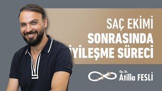 Saç Ekimi Sonrasında İyileşme Süreci Nasıl Oluyor?