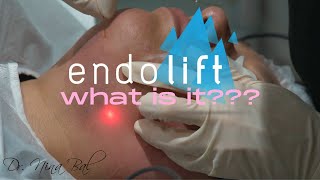 What is Endolift?  Skin Tightening & Fat Melting Treatment 💕 Endolift Explained by Dr Nina Bal