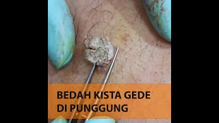 Kista di Punggung