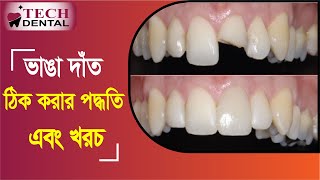 ভাঙা দাঁত  ঠিক করার পদ্ধতি কসমেটক । Tech Dental Care