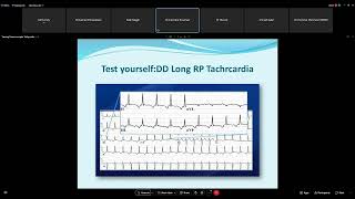 Narrow Complex Tachycardia   Dr  Mohamed Adam