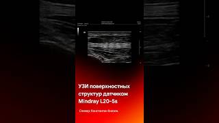 Поверхностные структуры на УЗИ датчике Mindray L20-5s #shorts #short #tiktok #reels #узи #medical