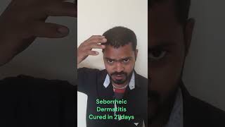 Seborrheic dermatitis & alopecia cured in 21 days  hairfall recovered