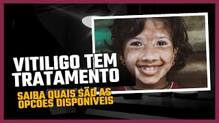 VITILIGO tem tratamento : saiba quais são as opcões disponíveis