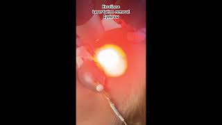 Laser eyebrow tattoo removal, removing eyebrow tattoo #lasertattooremoval #eyebrowtattoo