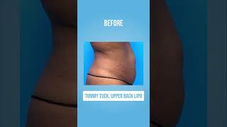 TUMMY TUCK, UPPER BACK LIPO🙌🏼✨