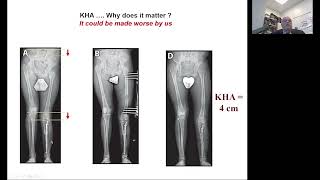 Asymmetrical knee height: A forgotten deformity- R Hamdy