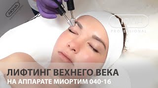 Лифтинг вехнего века