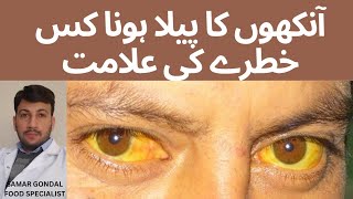 Yellow eyes causes and treatment | jaundice | آنکھوں کا پیلا ہونا کس خطرے کی علامت