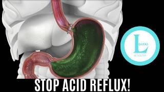 #1 Surprising Remedy for Heartburn - Acid Reflux(GERD Without Meds)