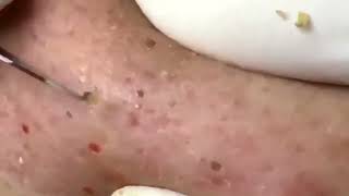 Ear blackhead professional extraction-Full video of blackhead removal on ear