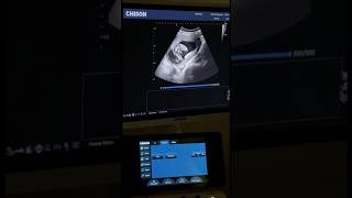 Ultrasound ( Just a boy being a BOY ) 😅💙 #boy #ultrasound #sonar #سونار #explore