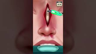 Nose Bone Surgery