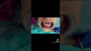 Tooth Restoration #pasta #dentalclinic | dental procedure