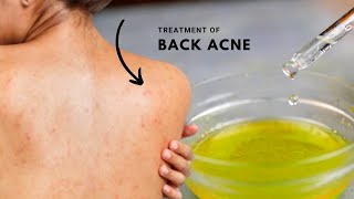 How To Get Rid Of Back Acne Overnight Fast In A Week - Bacne Treatment